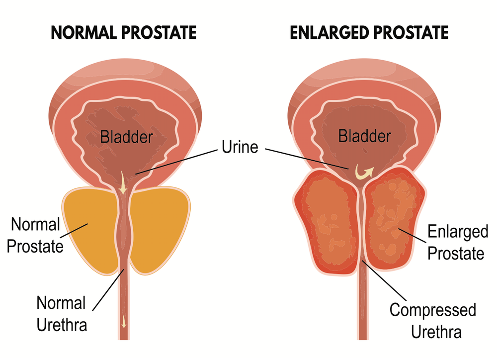 Prostatita Pushkar